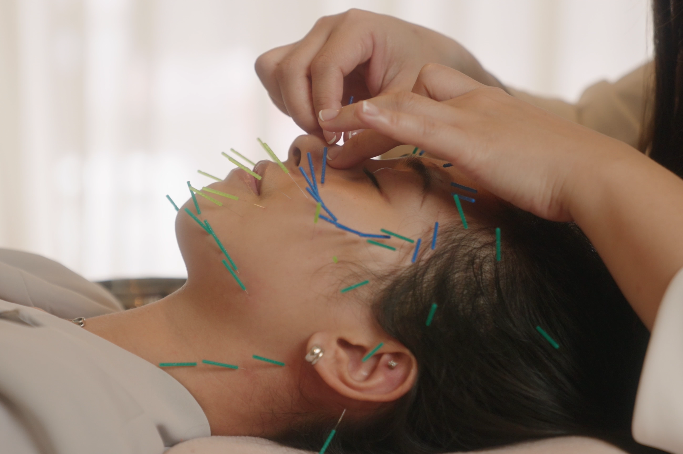 中醫美顏針,針灸原理,臉部針灸效果,中醫美容學