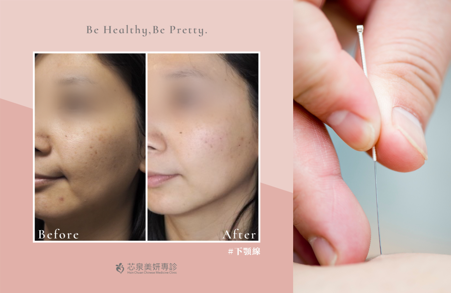 中醫美顏針,針灸原理,臉部針灸效果,中醫美容學